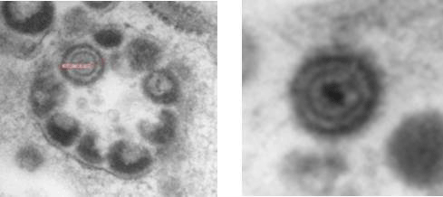 Fig. 1. Electron micrograph of varicella-zoster virus